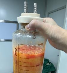 临沧水动力吸脂手术要做多久？